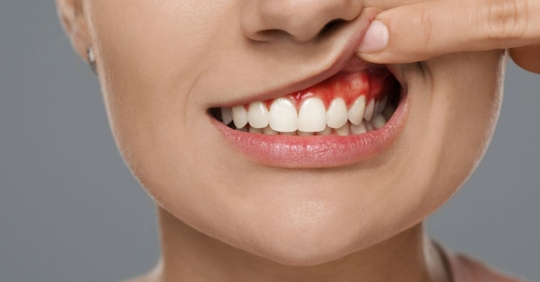 National Gum Care Month: Fight Gingivitis & Keep Your Smile Healthy