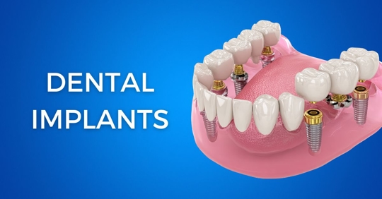 Dental Implants