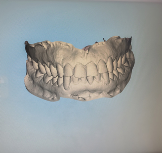 3D digital impressions