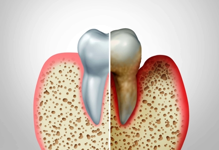 image of a normal health took compared to an infected damaged and decayed tooth gum disease model