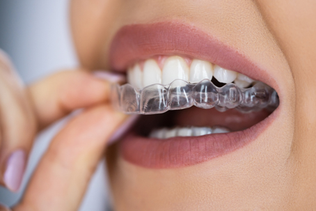 Woman putting in her clear aligners