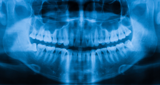 Dental X Ray