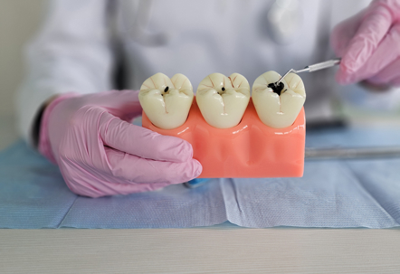 Dentist holding a model of teeth with cavities