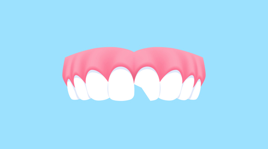 Graphic of chipped tooth