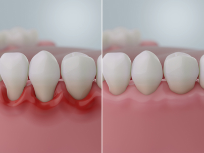 Graphic of unhealthy and healthy gums side by side