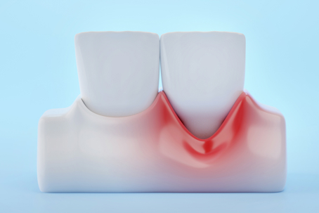 Graphic of receding gums