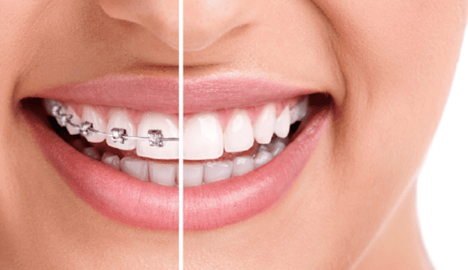 Teeth with & without brace