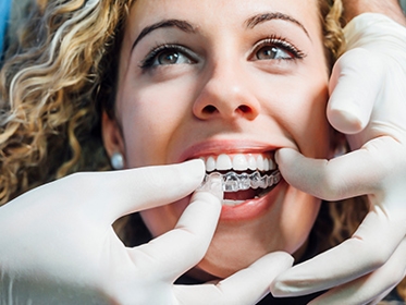 Invisalign®/Clear Aligners