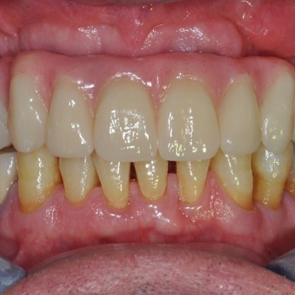 Dental Implants 1 Before