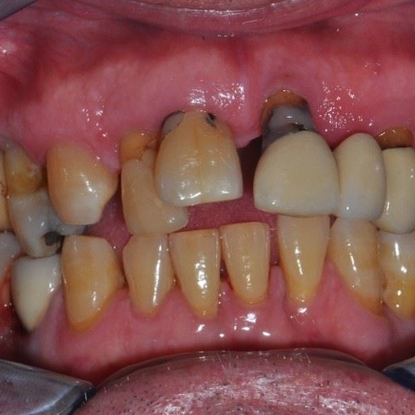 Dental Implants 1 After