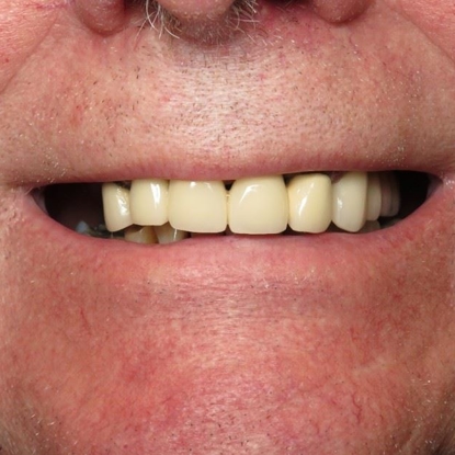 Dental Implants 2 After