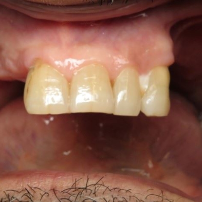 Dental Implants 3 After