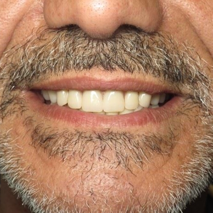 Dental Implants 4 Before