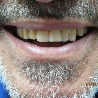 Dental Implants 4 After
