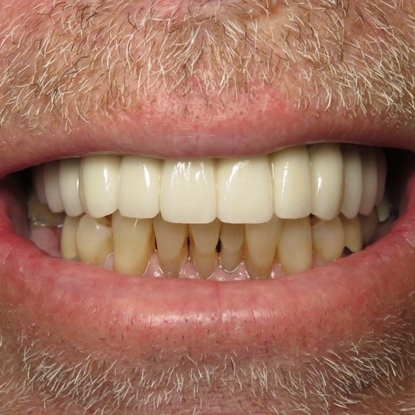 Dental Implants 5 Before