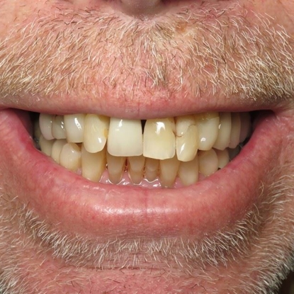 Dental Implants 5 After