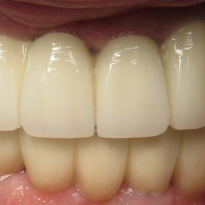 Dental Implants 6 Before