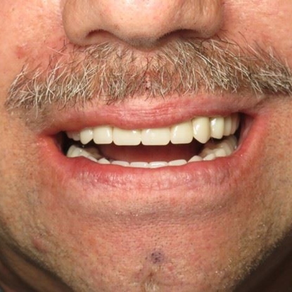 Dental Implants 7 Before