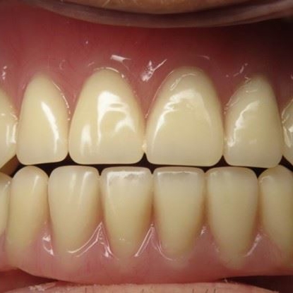 Dental Implants 8 Before