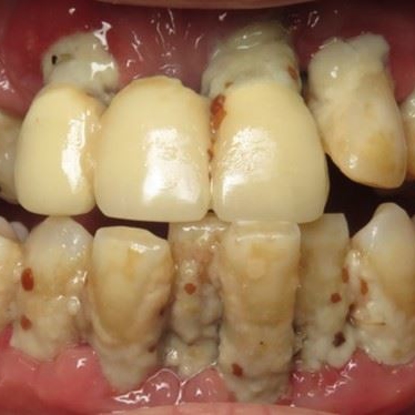 Dental Implants 8 After