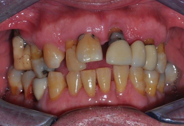 Dental Implants 1 Before & After Results